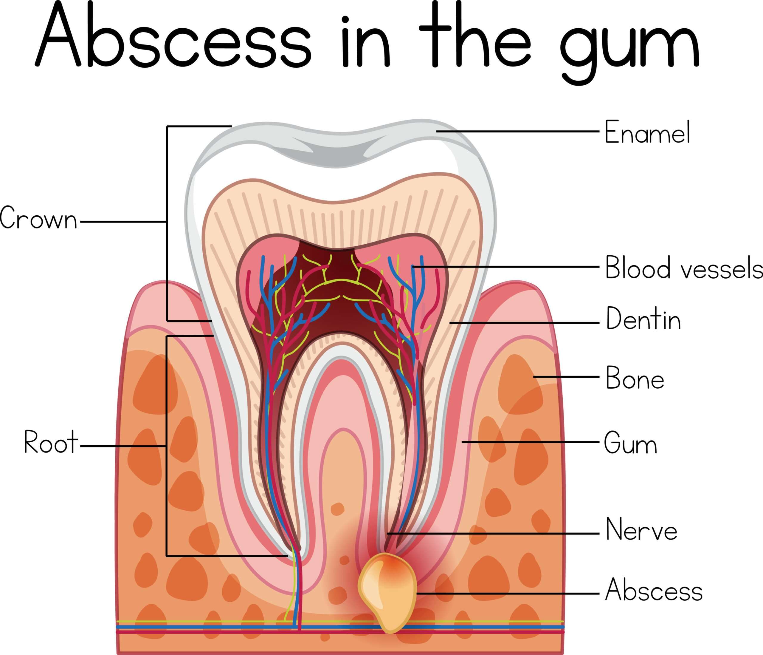 How To Drain A Mouth Abscess At Home â Tons of How To