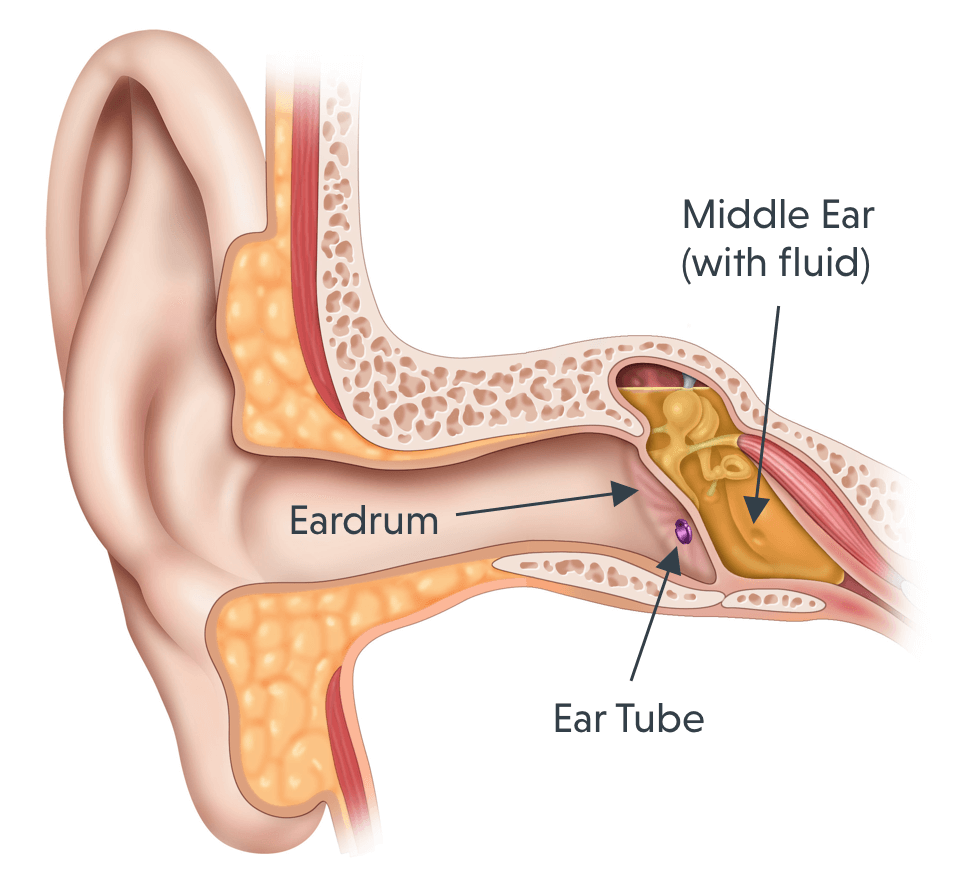 How To Drain Fluid In Middle Ear