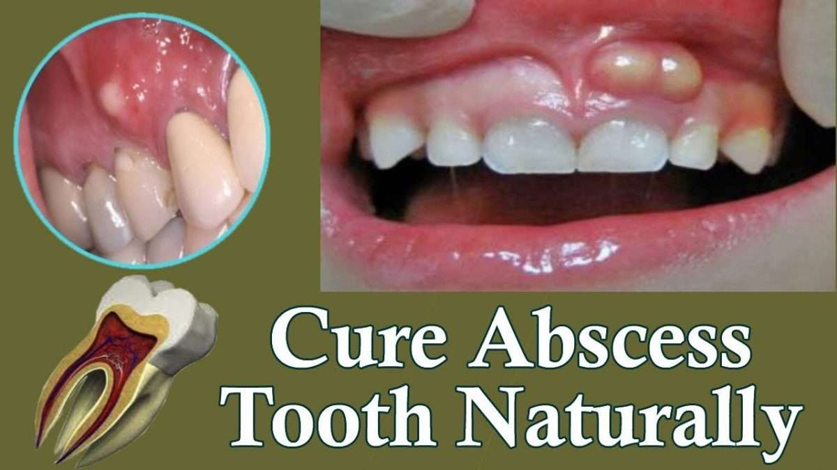 How To Get Rid Of A Gum Dental Abscess Oral Infection On GUMS Instant ...