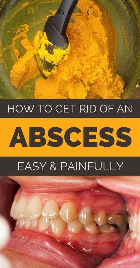 How to Get Rid of an Abscess Painless and Naturally