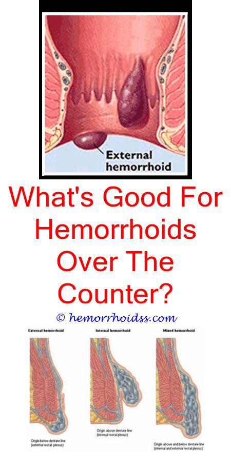 How To Get Rid Of Hemorrhoids Naturally At Home? what cream for ...