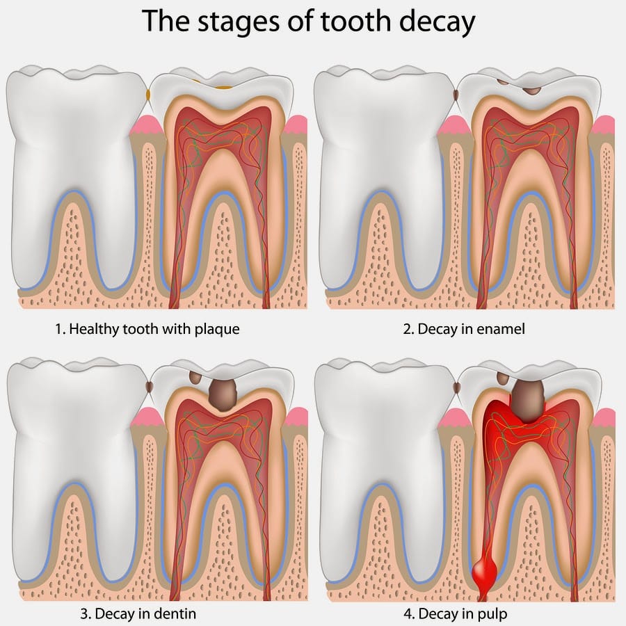 How to get rid of swollen gums around wisdom teeth jokes, how to get ...