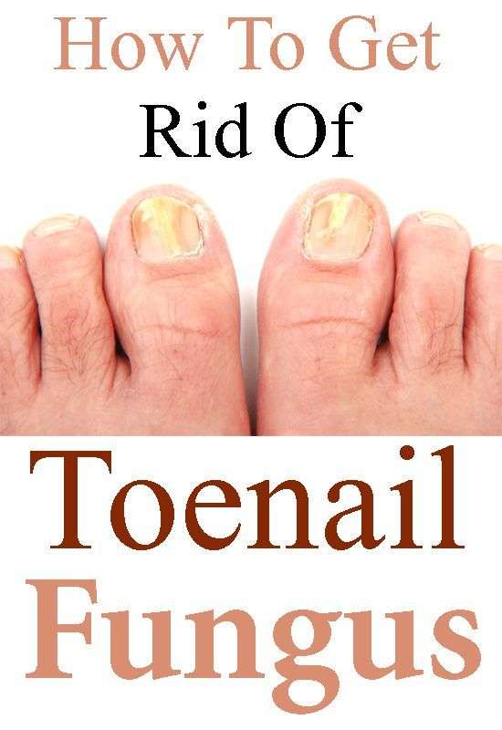 How To Get Rid Of Toenail Fungus