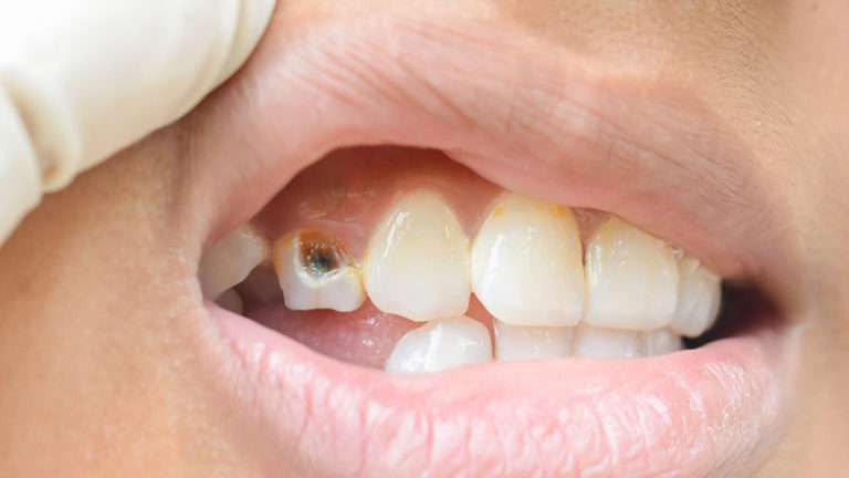 How to identify and treat a dead tooth