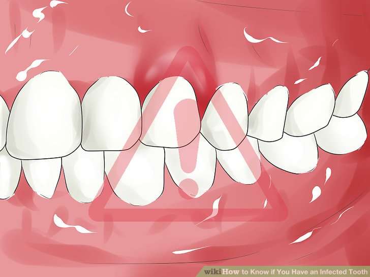 How to Know if You Have an Infected Tooth: 7 Steps (with Pictures)