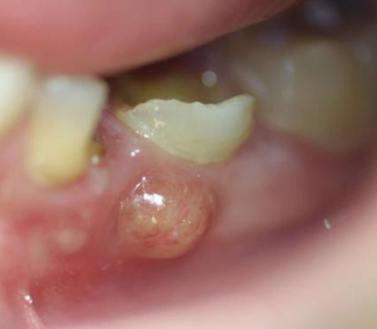 How to Pop a Dental Abscess by Yourself