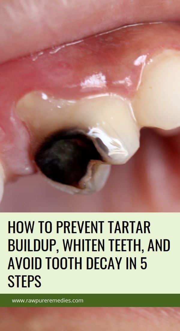 How to Prevent Tartar Buildup, Whiten Teeth, and Avoid Tooth Decay In 5 ...