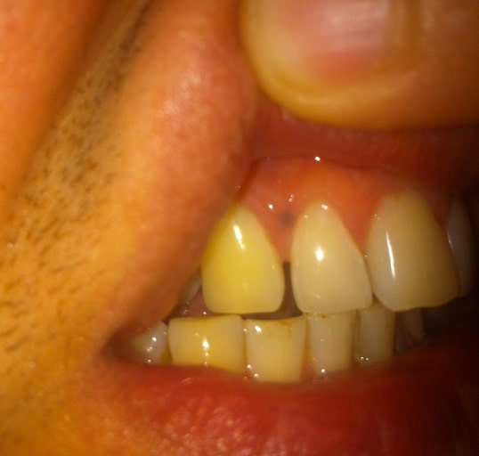 How To Reduce Black Mark On Gums
