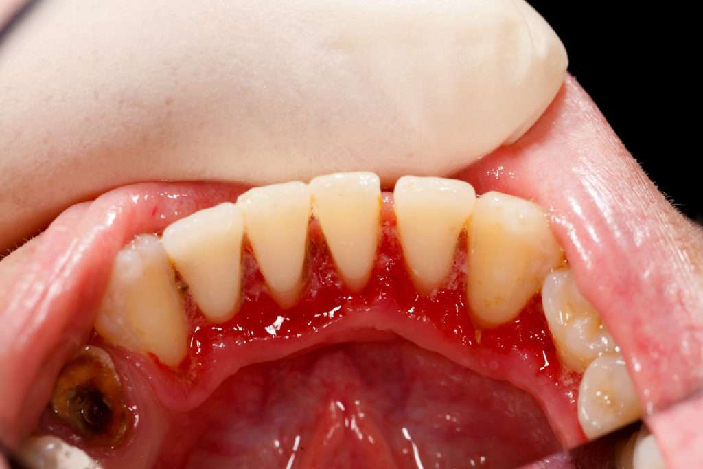 How to Reverse Gum Disease