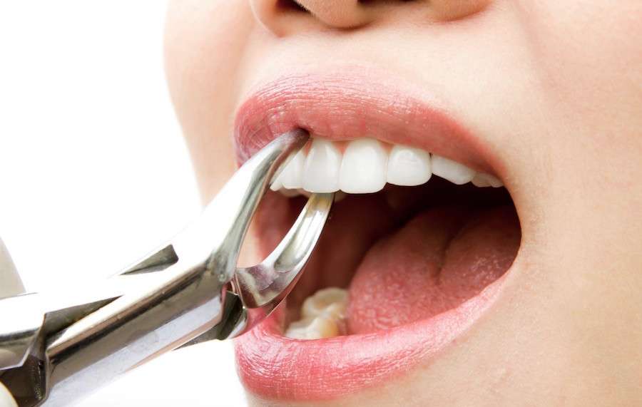 How to Save an Infected Tooth from Extraction