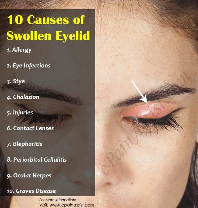 How To Treat A Stye On The Eyelid