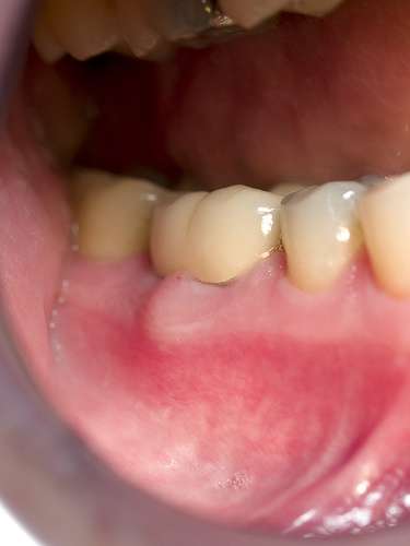 How to treat a Tooth with an Infected Old Crown