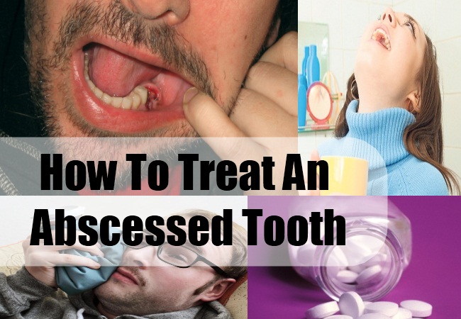 How To Treat An Abscessed Tooth