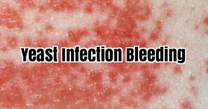 How To Treat Yeast Infection Bleeding