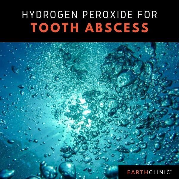 How to Use Hydrogen Peroxide for a Tooth Abscess