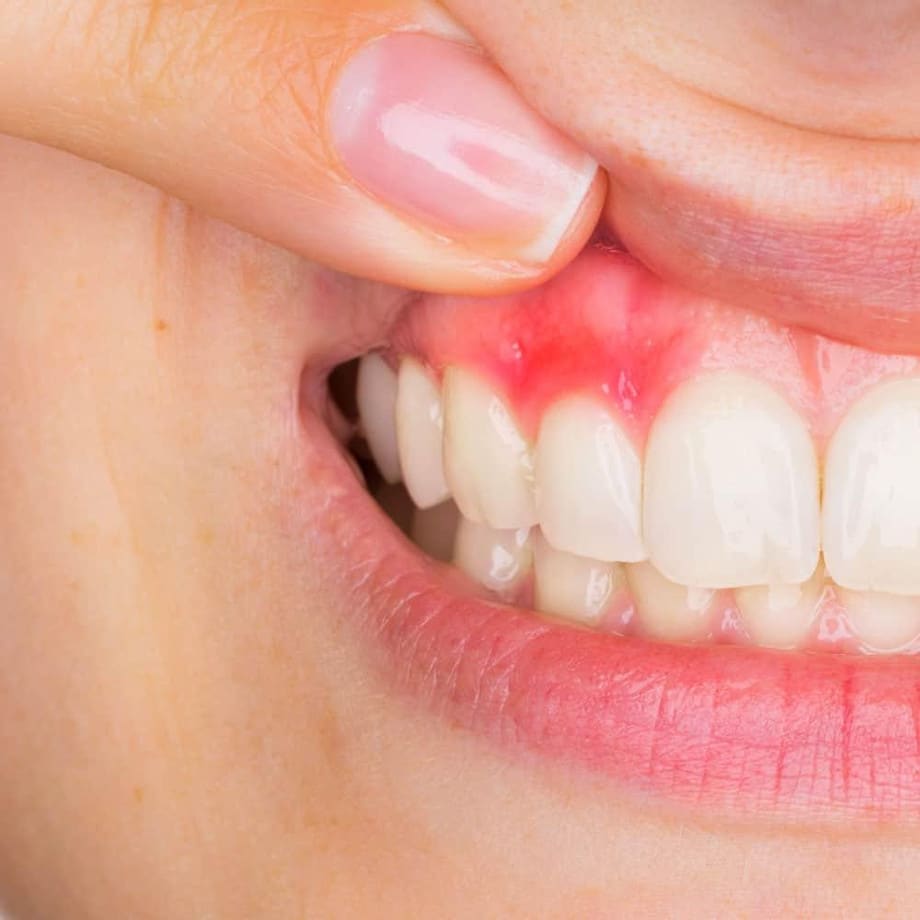 How You Can Treat The Periodontal Abscess?  Emergency Dentist