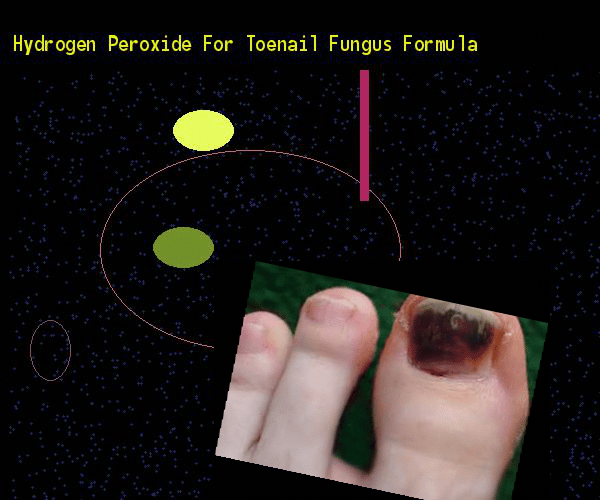 Hydrogen peroxide for toenail fungus formula