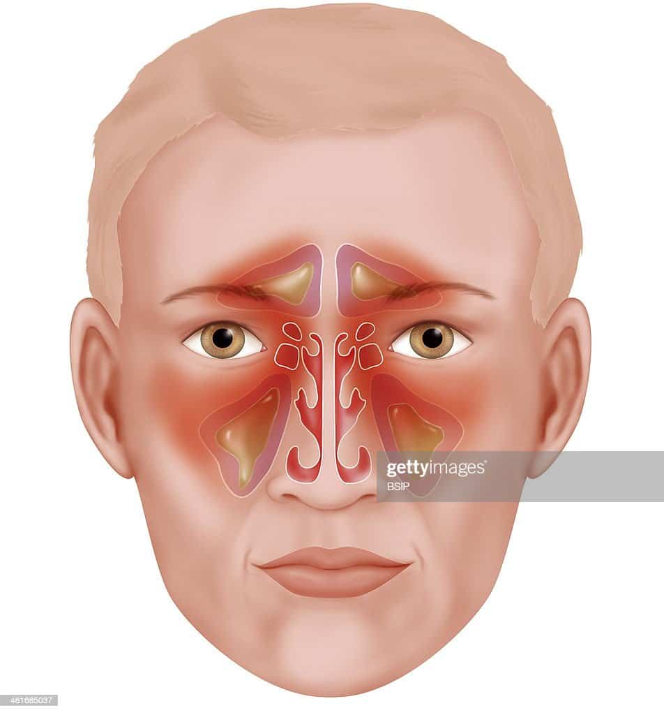 Illustration of the various paranasal sinuses that are infected... News ...