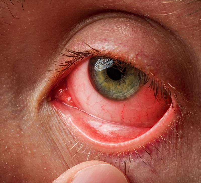 Infected eye: Types, causes, and treatment