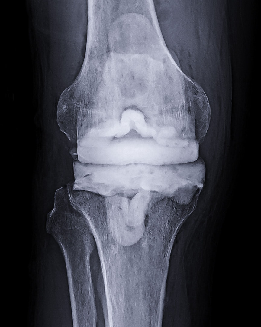 Infected Knee Replacement  ADAM SASSOON M.D., M.S.