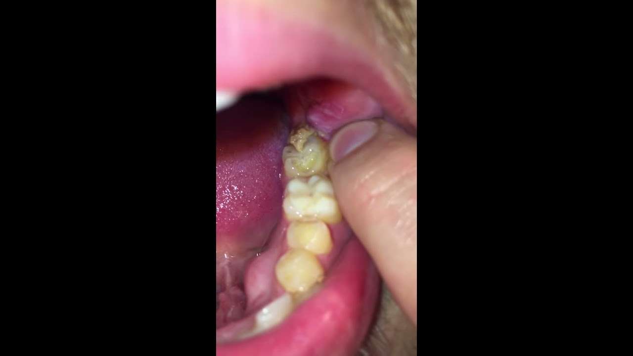 Infection after wisdom teeth removal