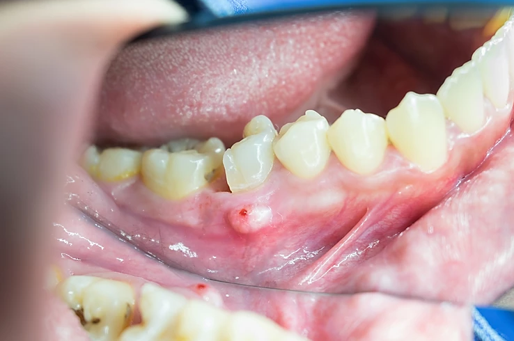 " Infection in baby tooth" : Treatment Possibilities:
