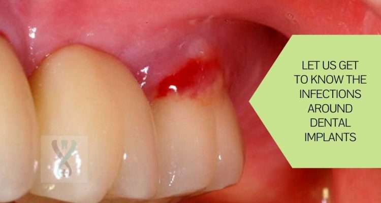 Infections around Dental Implants  How they manifest ...