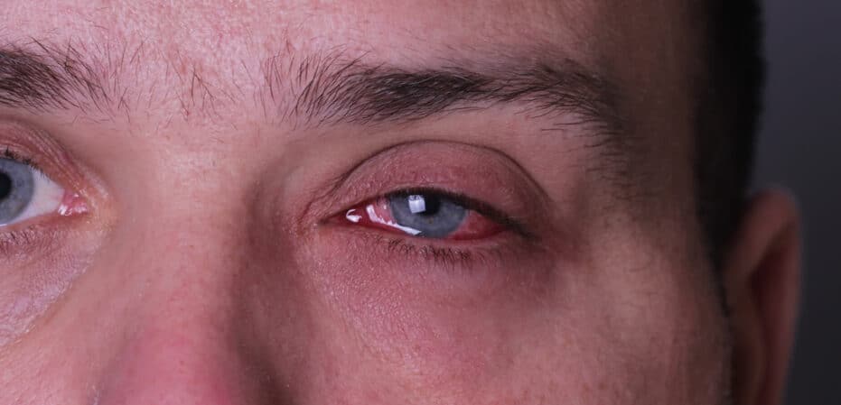 Infections/Pink Eye