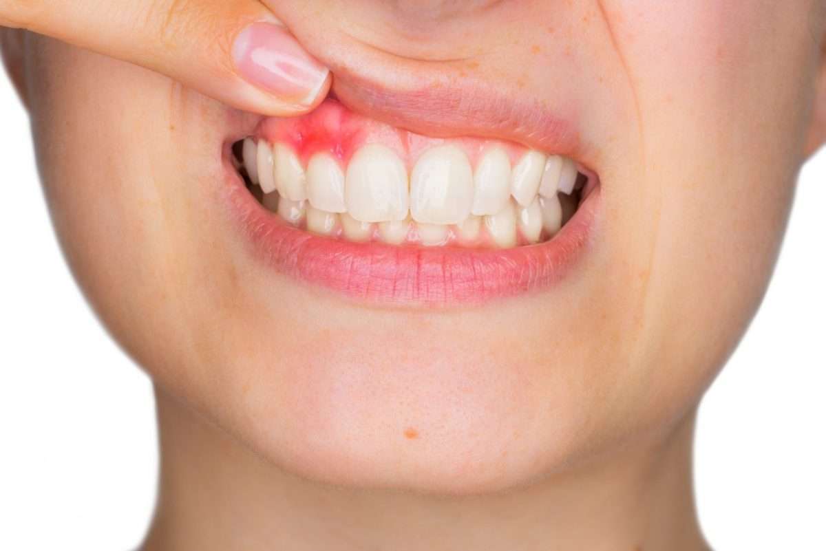 Inflamed, Swollen Gums: The Telltale Signs You Have Gingivitis