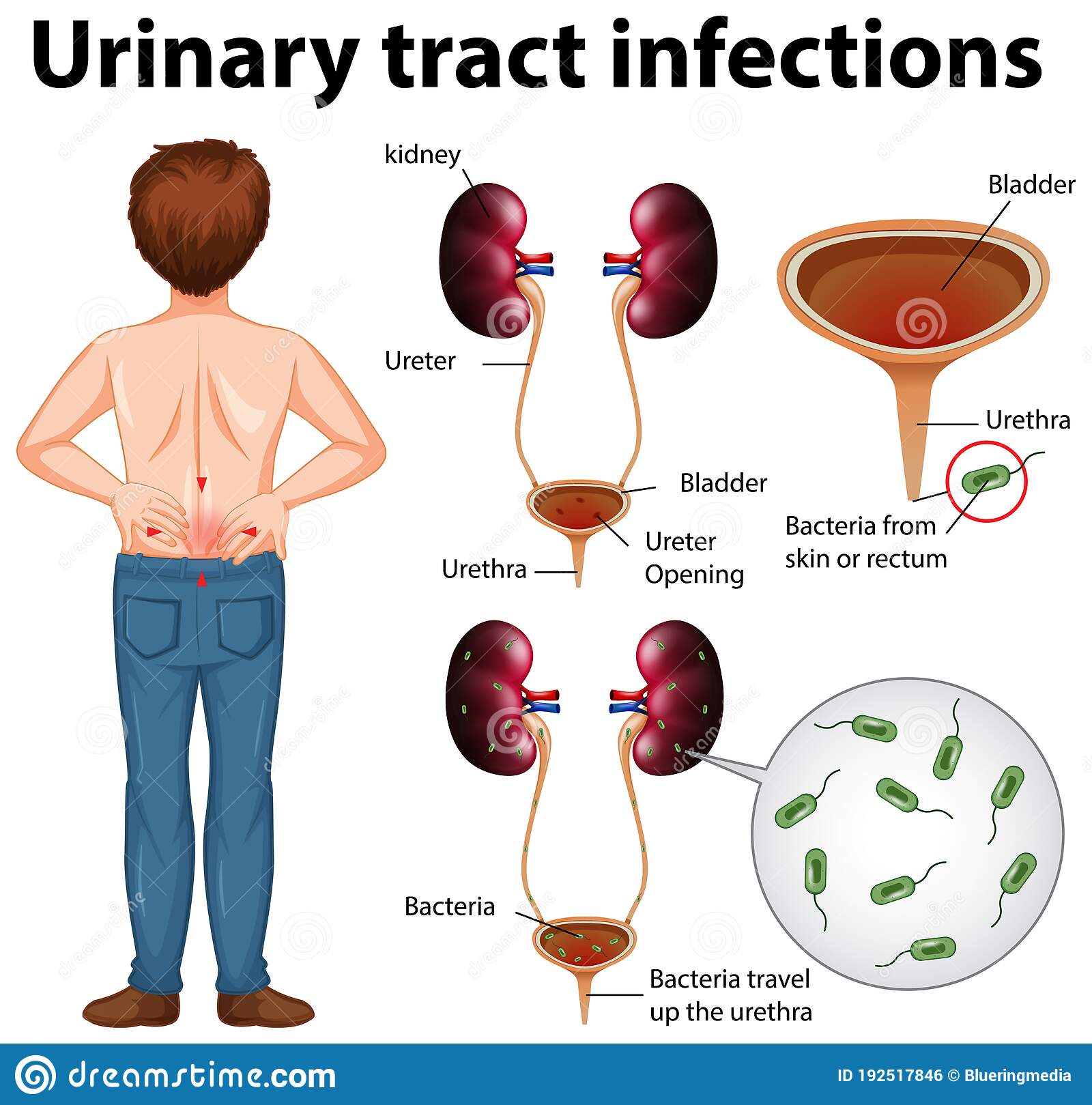 Informative Illustration Of Urinary Tract Infections Stock Vector ...