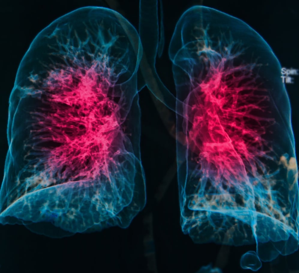 Inhaled Corticosteroids Do Not Increase Risk for Pneumonia in COPD