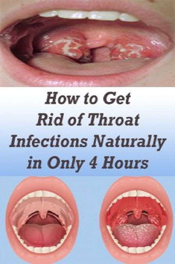 Instructions to Get Rid of Throat Infections Naturally in Only 4 ...