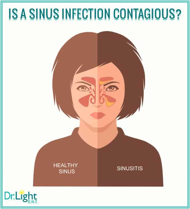 Is a #SinusInfection #Contagious? Click for #Facts