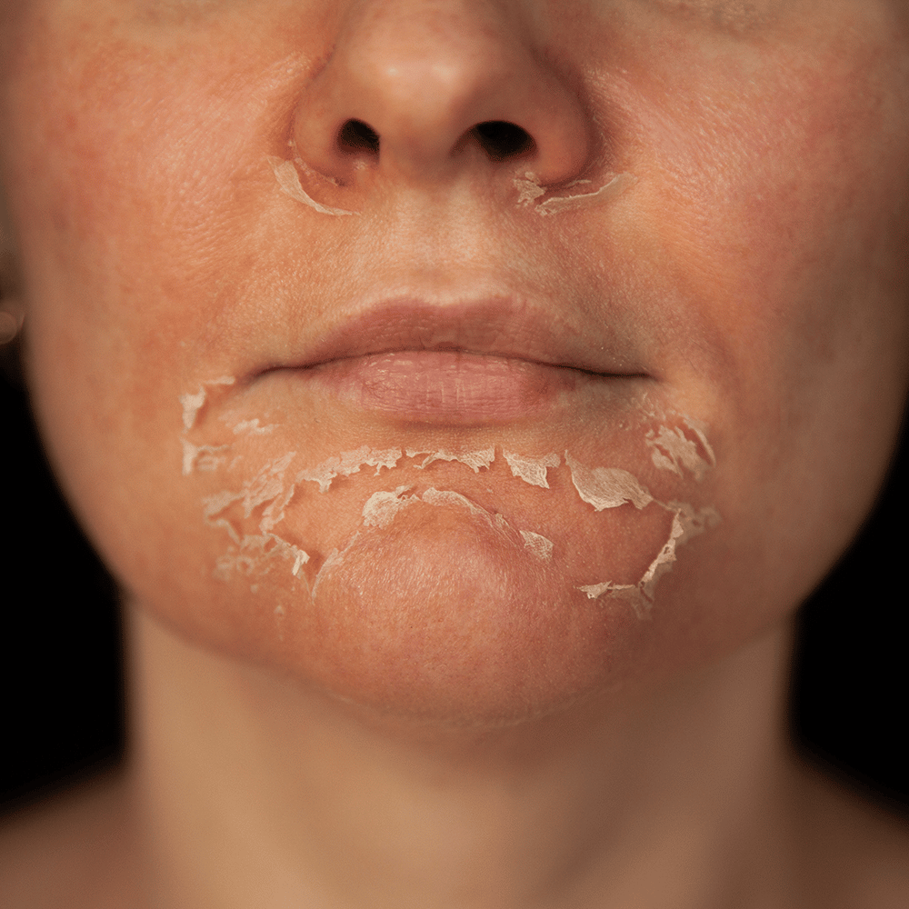 Is Eczema Contagious? What You Need to Know