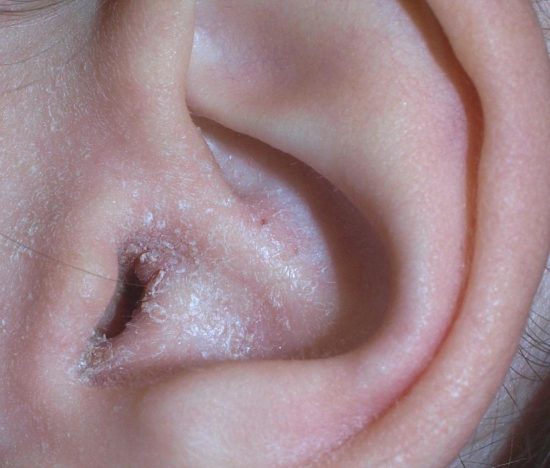 Itchy Ear Canal: Causes, Picture, Symptoms, And Treatment