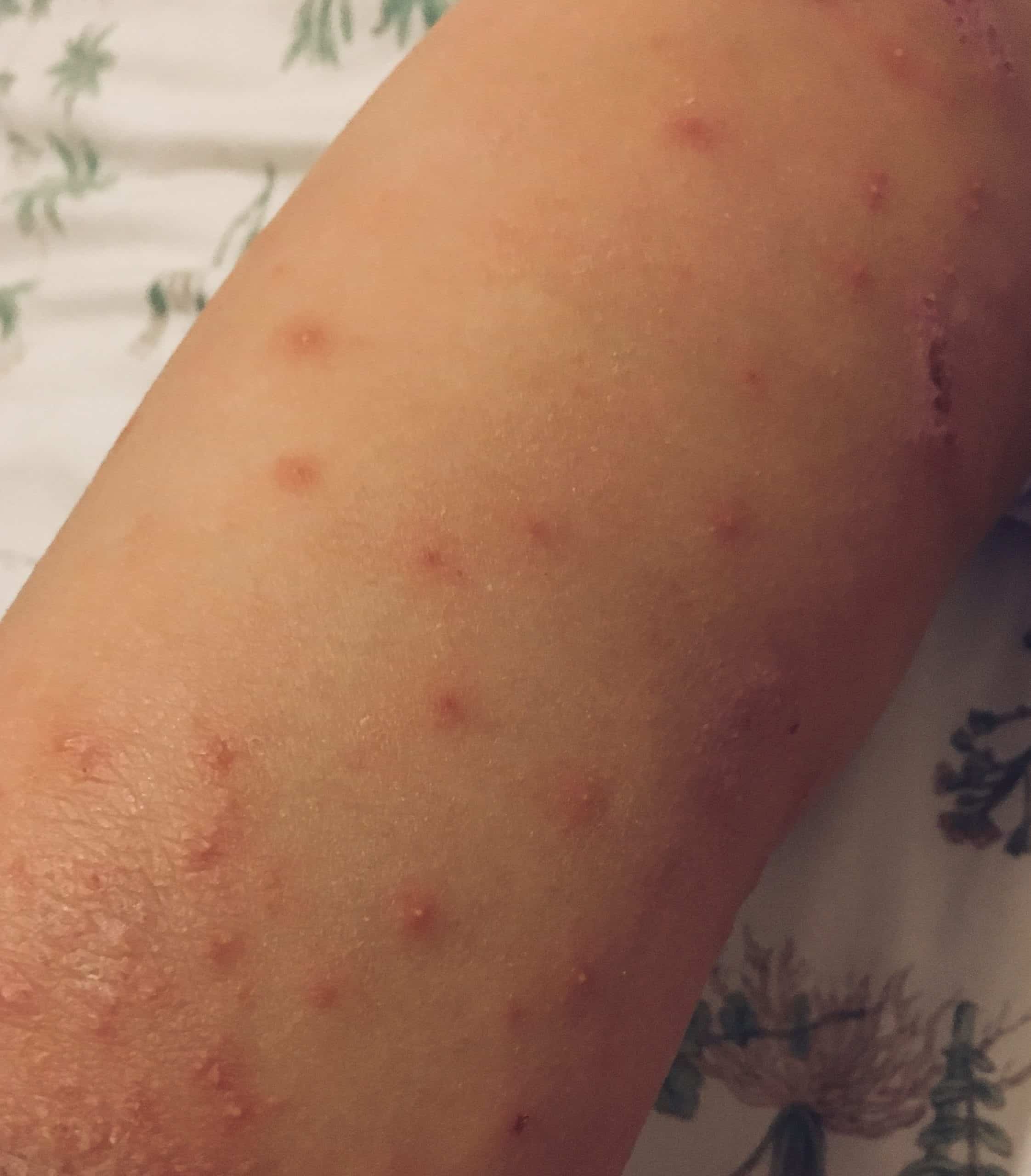 Ivy, Eczema, and a Bacterial Infection