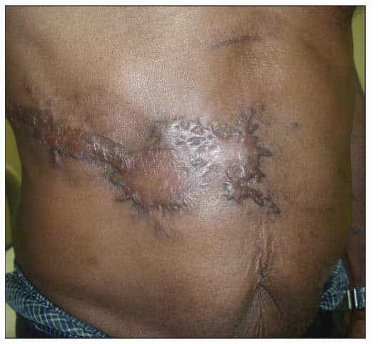 Keloid After Herpes Zoster in an HIV