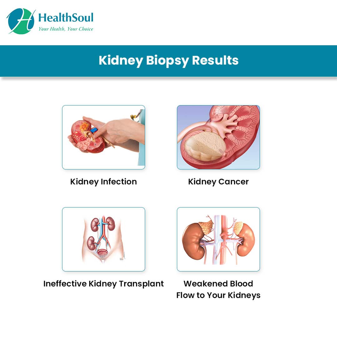Kidney Biopsy