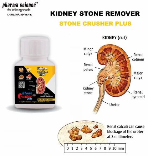 Kidney Infection, Packaging Size: 15 g, Rs 1399 /unit Pharma Science ...