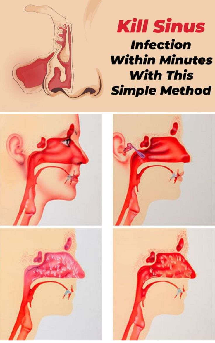 Kill Sinus Infection Within Minutes, With What You Have In ...