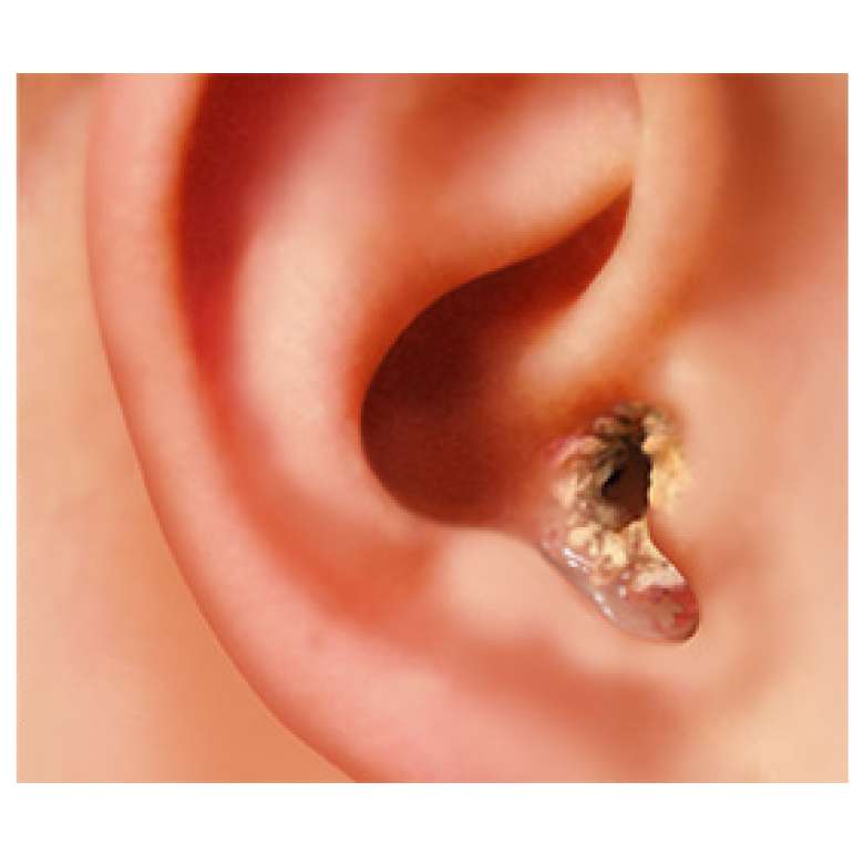 Learn About EAR Infections