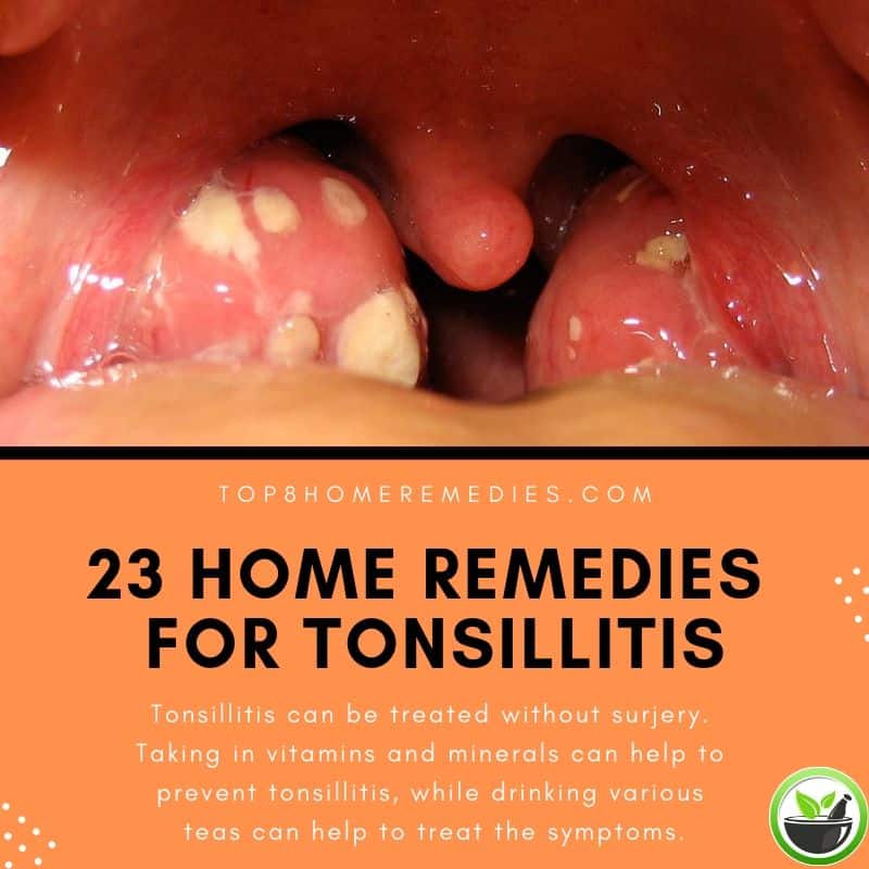 Learn how to prevent tonsillitis and treat its symptoms with the use of ...