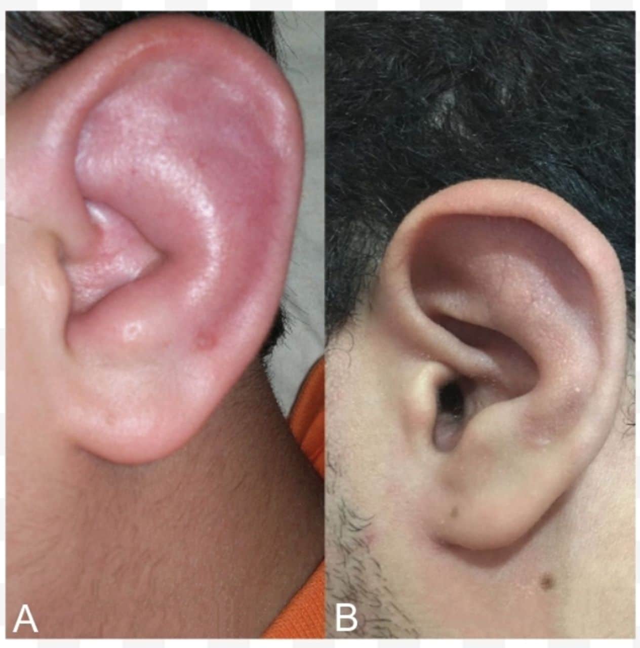 Limited auricular relapsing polychondritis in a child treated ...