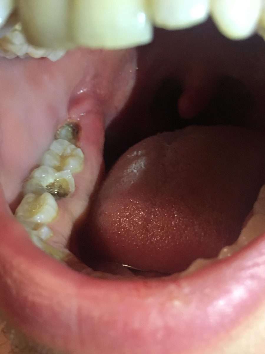 Looking for advice. My friends tooth at the back is infected. Hes ...