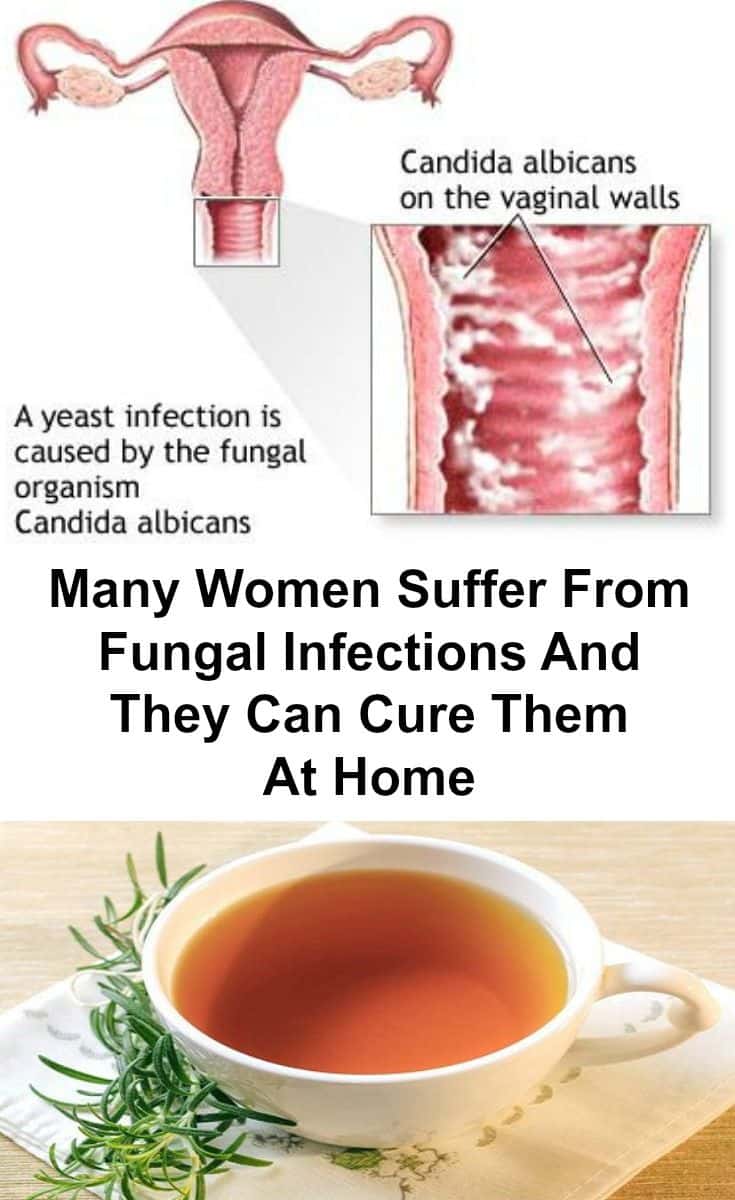 Many Women Suffer From Fungal Infections And They Can Cure Them At Home ...