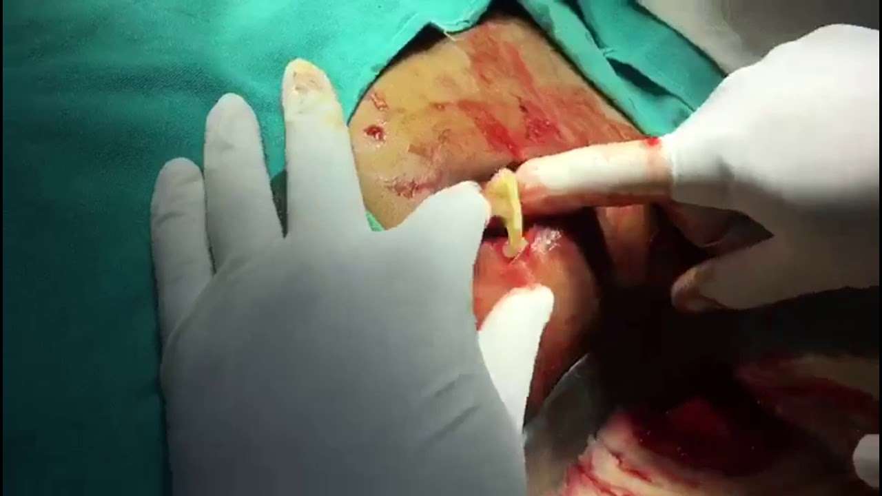 Mesh removal surgery due to infection after hernia surgery ...