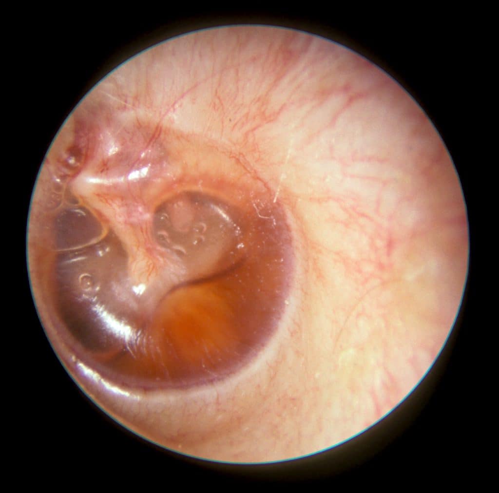 Middle Ear Effusion