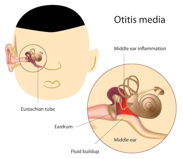 Middle Ear Infection (Chronic Otitis Media) in Children