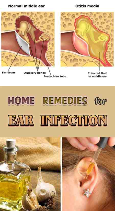 Middle Ear Infection Natural Treatments Cropped Infections ...
