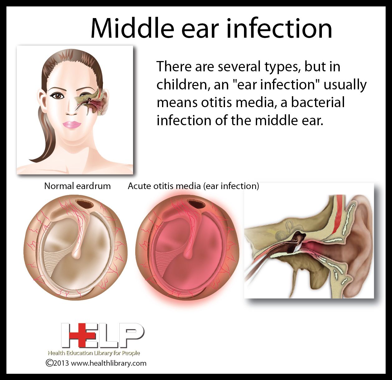 Middle Ear Infection